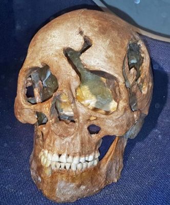 Jacob Erlandsen's skull