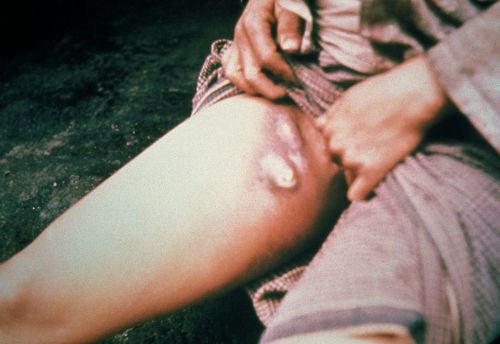 An abscess on the inner thigh of a person infected with bubonic plague